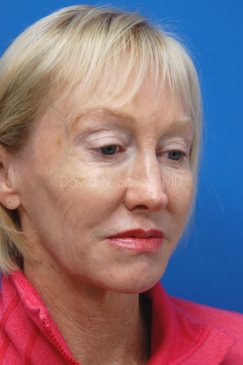 Co2 Laser Before and After | Sayah Institute