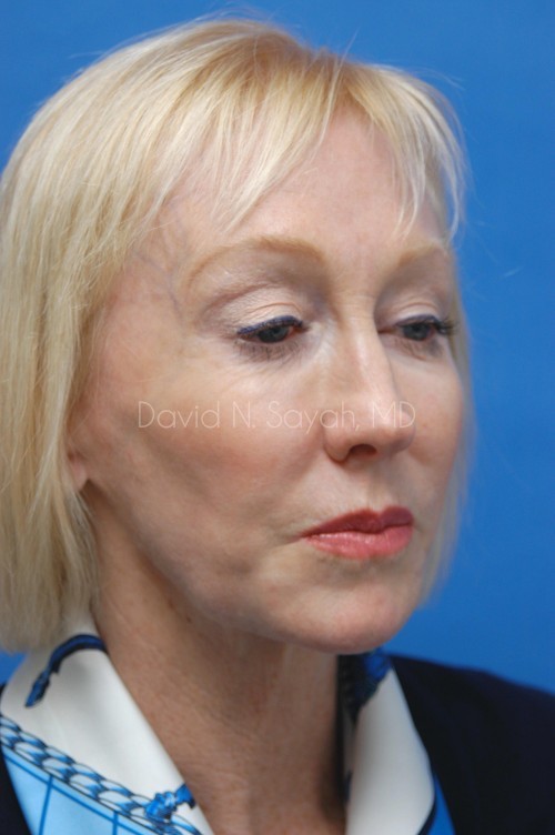 Co2 Laser Before and After | Sayah Institute