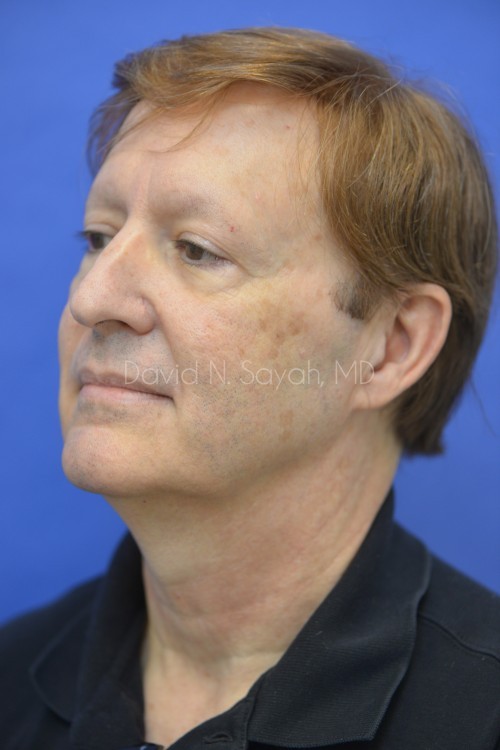 Co2 Laser Before and After | Sayah Institute