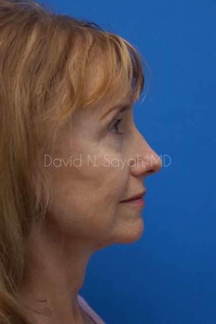 Co2 Laser Before and After | Sayah Institute