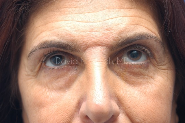 Endoscopic Brow Lift Before and After | Sayah Institute