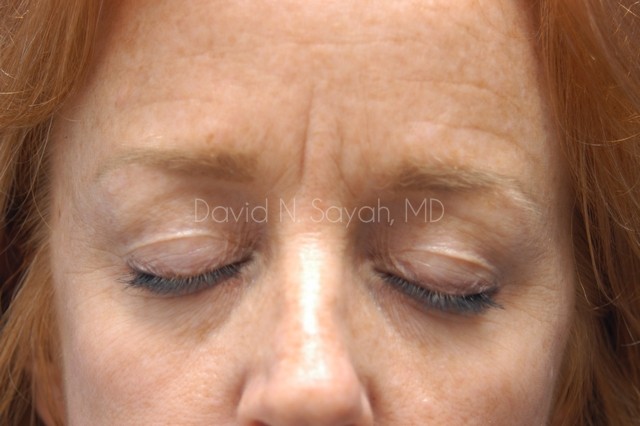 Endoscopic Brow Lift Before and After | Sayah Institute