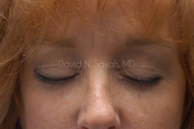Endoscopic Brow Lift Before and After | Sayah Institute