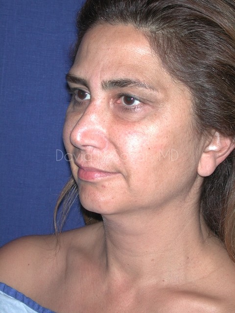 Endoscopic Brow Lift Before and After | Sayah Institute