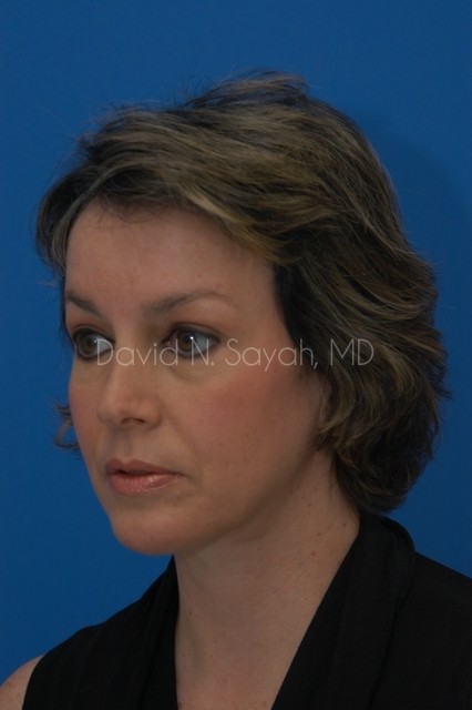 Endoscopic Facelift Before and After | Sayah Institute