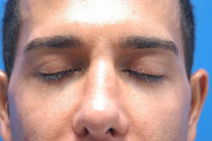 Eyelid Surgery Before and After | Sayah Institute