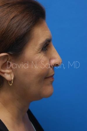 Facelift Before and After | Sayah Institute