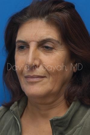 Facelift Before and After | Sayah Institute