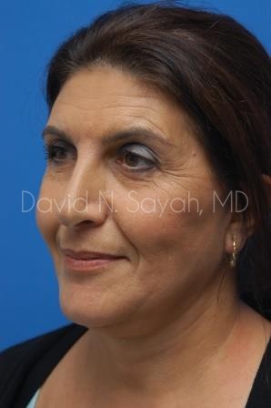 Facelift Before and After | Sayah Institute