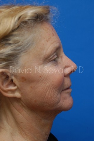 Facelift Before and After | Sayah Institute