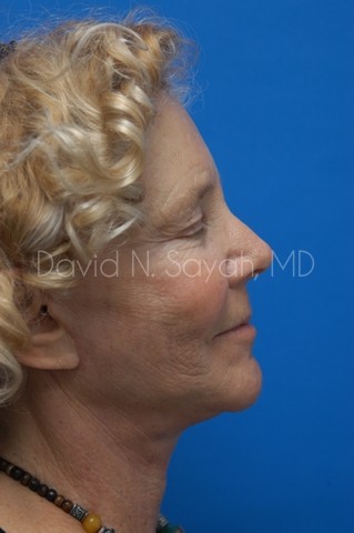 Facelift Before and After | Sayah Institute