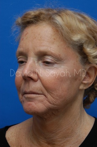 Facelift Before and After | Sayah Institute