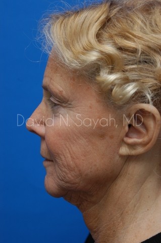 Facelift Before and After | Sayah Institute