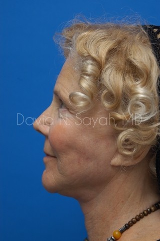 Facelift Before and After | Sayah Institute