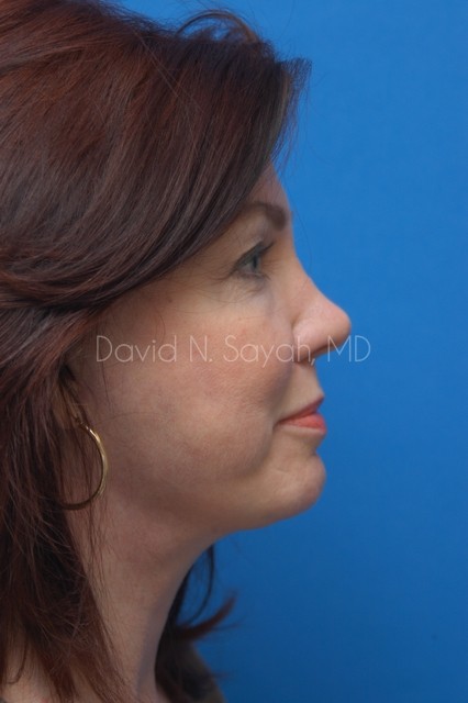 Facelift Before and After | Sayah Institute