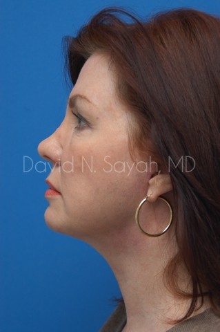 Facelift Before and After | Sayah Institute