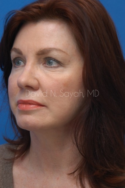 Facelift Before and After | Sayah Institute