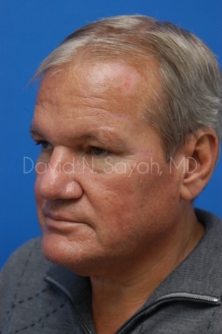 Facelift Before and After | Sayah Institute