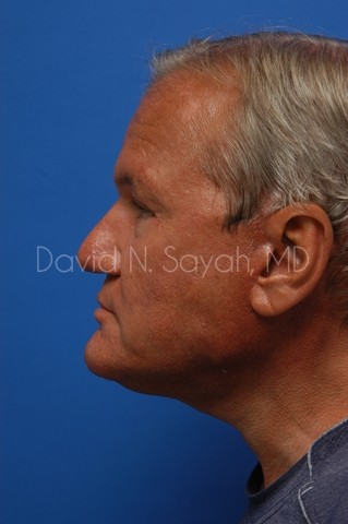 Facelift Before and After | Sayah Institute