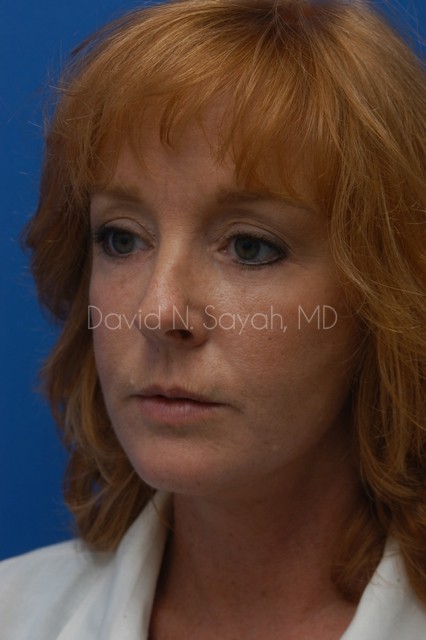 Facelift Before and After | Sayah Institute