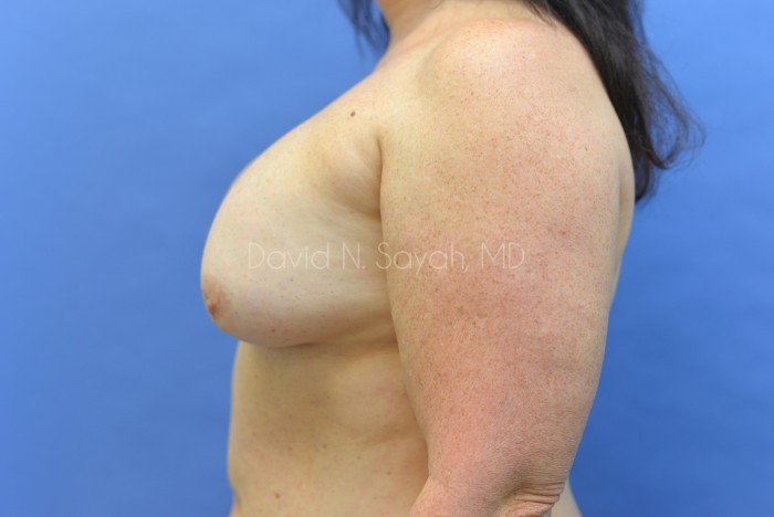 Fat Injection Breast Before and After | Sayah Institute
