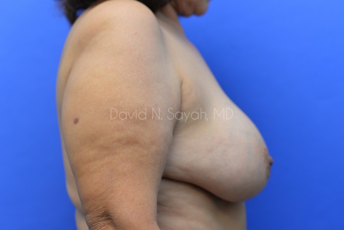 Fat Injection Breast Before and After | Sayah Institute