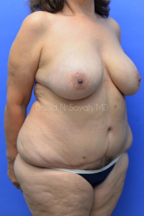 Fat Injection Breast Before and After | Sayah Institute