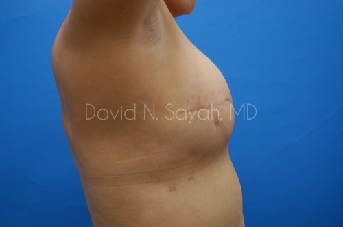 Fat Injection Breast Before and After | Sayah Institute