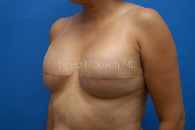 Fat Injection Breast Before and After | Sayah Institute