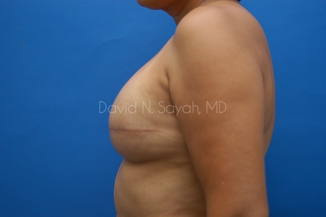 Fat Injection Breast Before and After | Sayah Institute