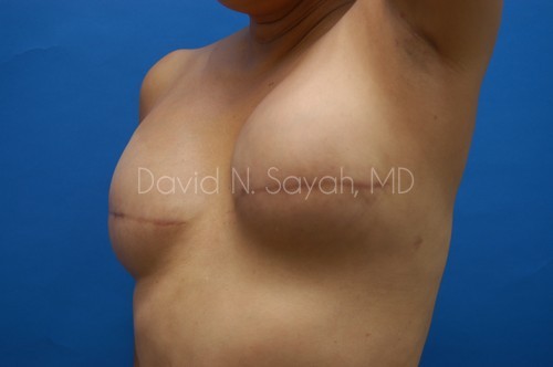 Fat Injection Breast Before and After | Sayah Institute
