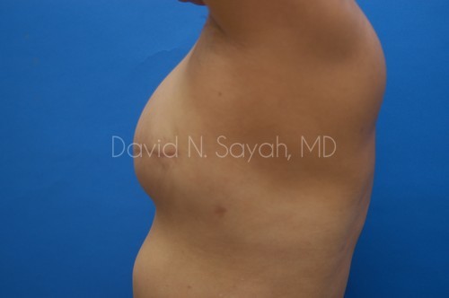 Fat Injection Breast Before and After | Sayah Institute