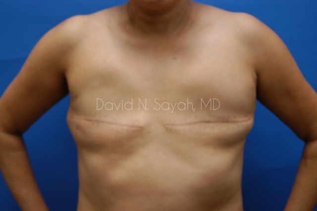Fat Injection Breast Before and After | Sayah Institute