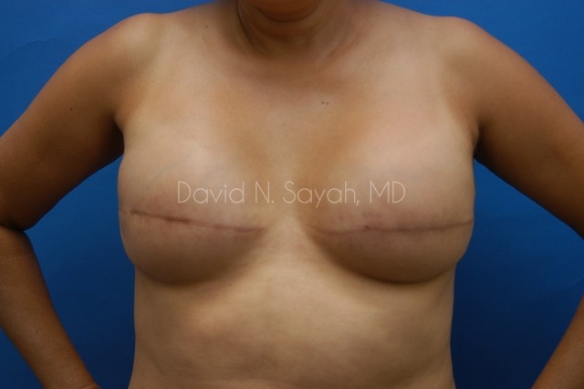 Fat Injection Breast Before and After | Sayah Institute