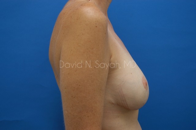 Fat Injection Breast Before and After | Sayah Institute