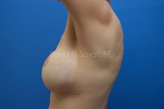 Fat Injection Breast Before and After | Sayah Institute