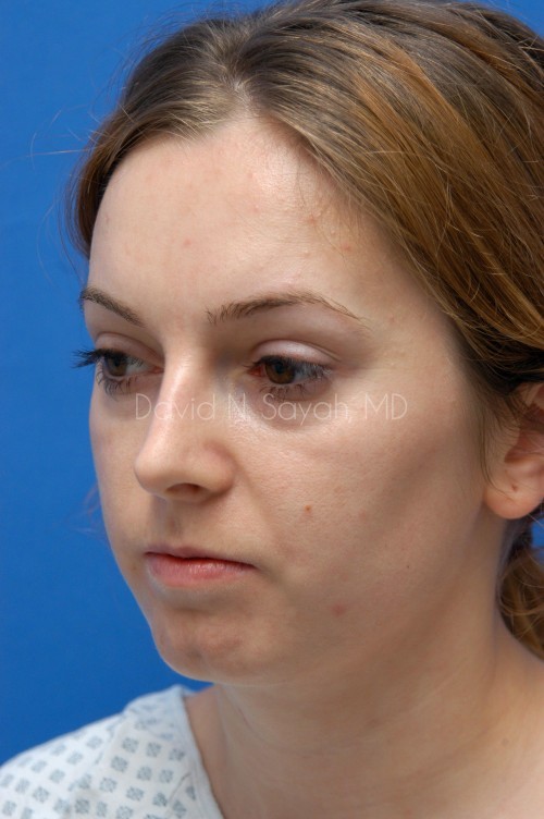 Fat Injection Face Before and After | Sayah Institute