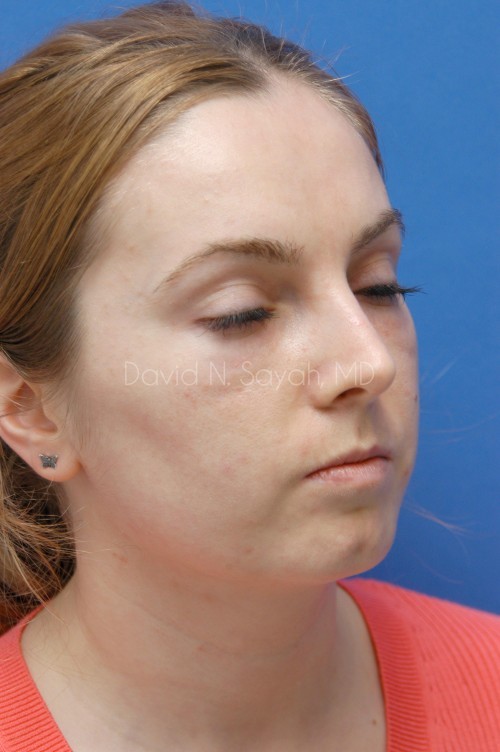 Fat Injection Face Before and After | Sayah Institute
