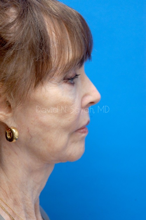 Fat Injection Face Before and After | Sayah Institute