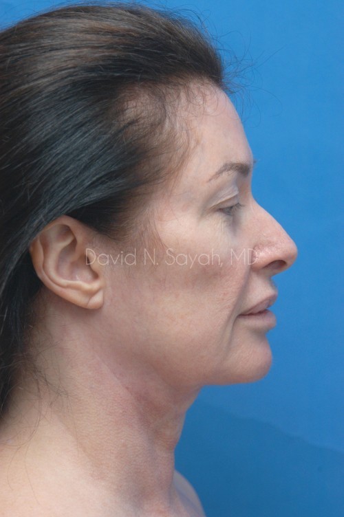 Fat Injection Face Before and After | Sayah Institute