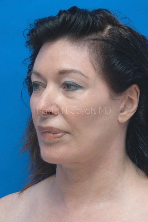 Fat Injection Face Before and After | Sayah Institute
