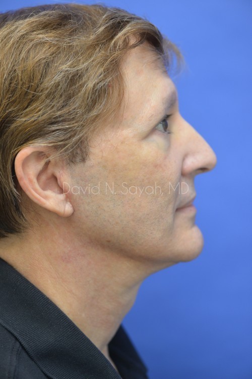 Fat Injection Face Before and After | Sayah Institute