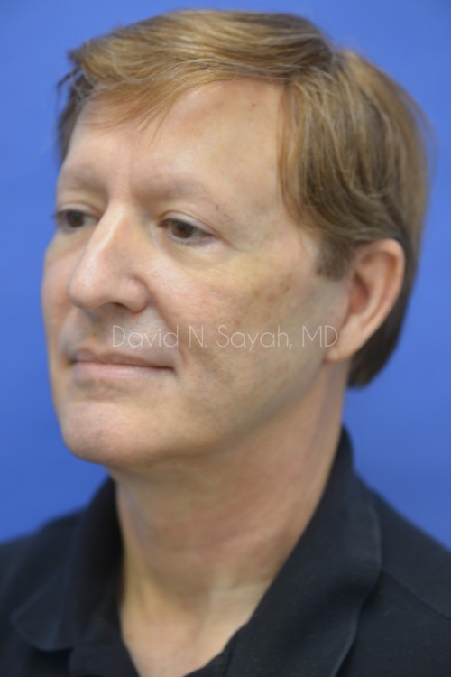 Fat Injection Face Before and After | Sayah Institute