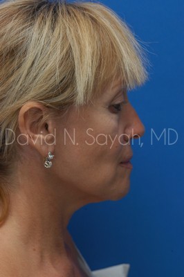 Fat Injection Face Before and After | Sayah Institute