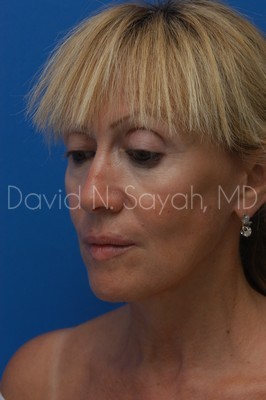 Fat Injection Face Before and After | Sayah Institute