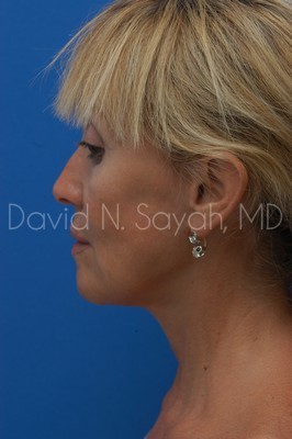 Fat Injection Face Before and After | Sayah Institute