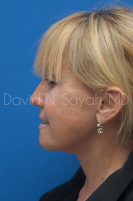 Fat Injection Face Before and After | Sayah Institute