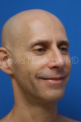 Fat Injection Face Before and After | Sayah Institute