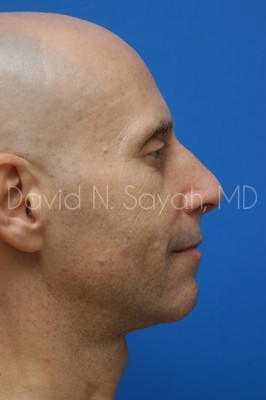 Fat Injection Face Before and After | Sayah Institute