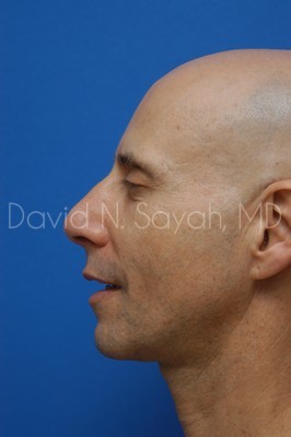 Fat Injection Face Before and After | Sayah Institute